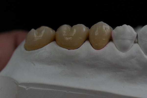 fija_metal_ceramica
