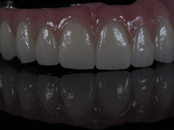 fija_zirconio_ceramica