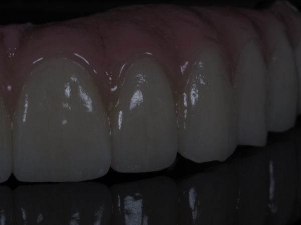 fija_zirconio_ceramica