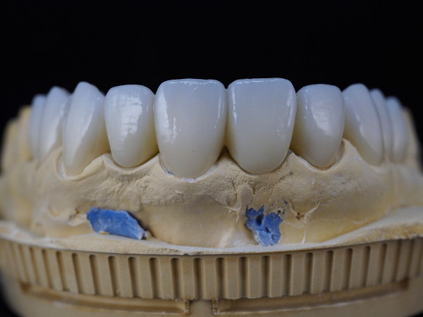 fija_zirconio_ceramica
