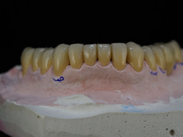 fija_zirconio_ceramica