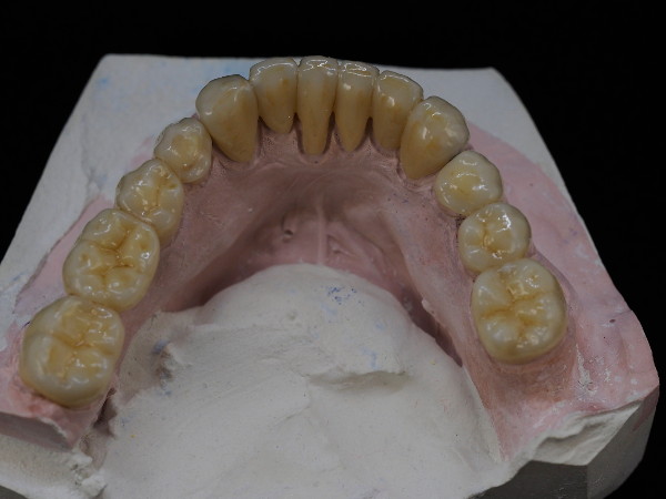 fija_zirconio_ceramica