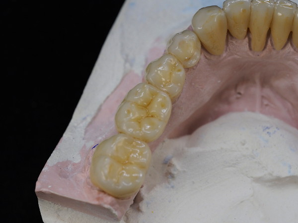 fija_zirconio_ceramica