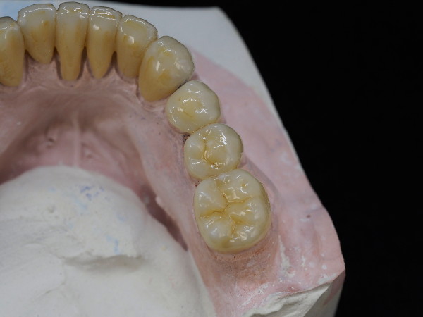 fija_zirconio_ceramica