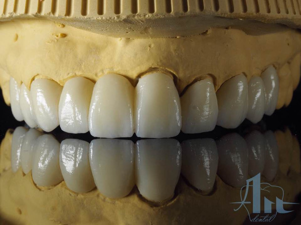 fija_zirconio_ceramica