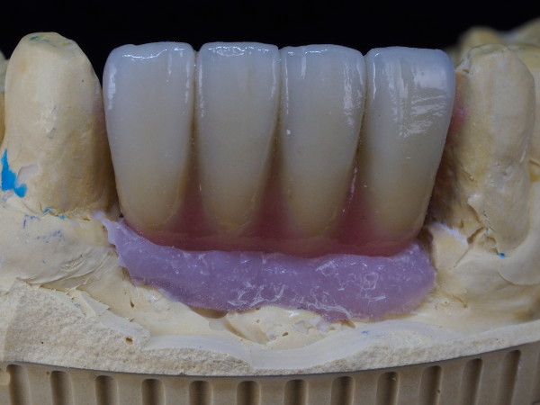 implante_metal_ceramica