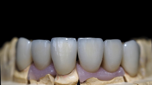 implante_metal_ceramica