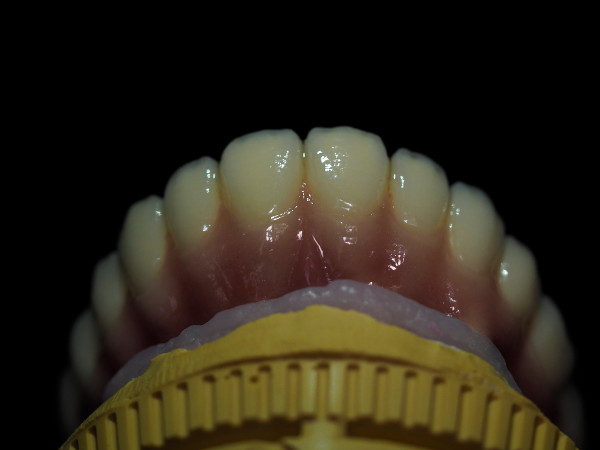 implante_metal_ceramica