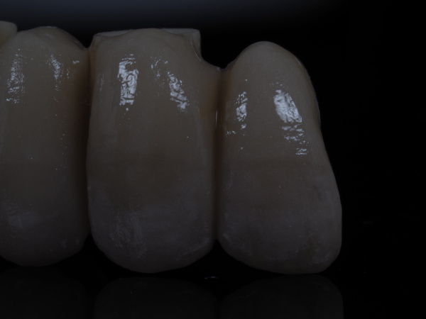 implante_zirconio_ceramica