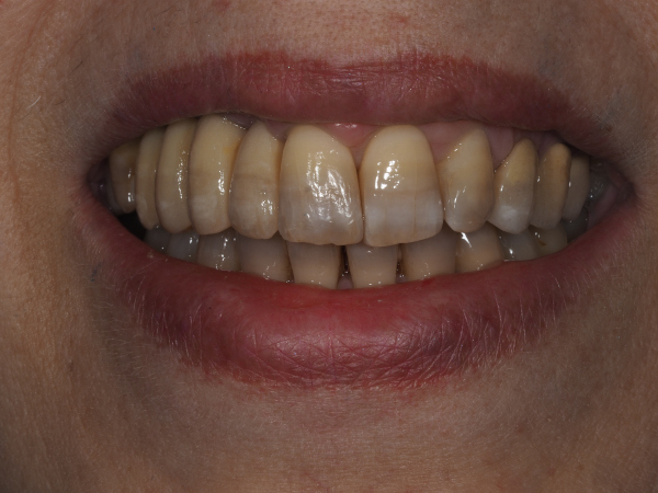 implante_zirconio_ceramica