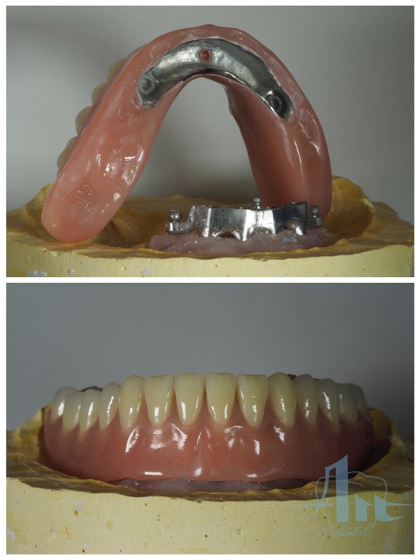 removible_sobre_dentadura